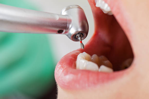 Best Emergency Root Canal Therapy in Abingdon, IL